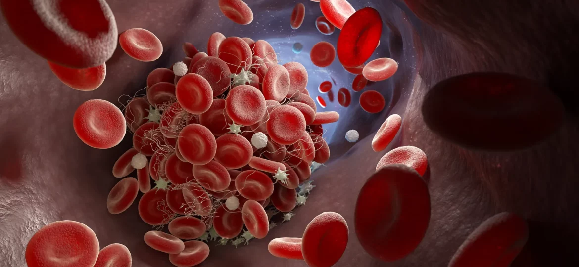 unveiling-Intricacies- hypertrophic-cardiomyopathy-blood-clot