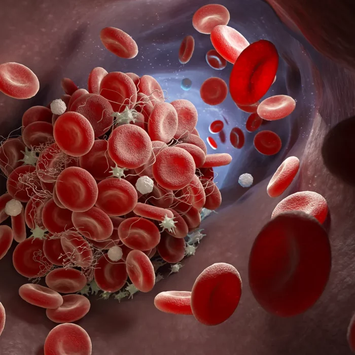 unveiling-Intricacies- hypertrophic-cardiomyopathy-blood-clot