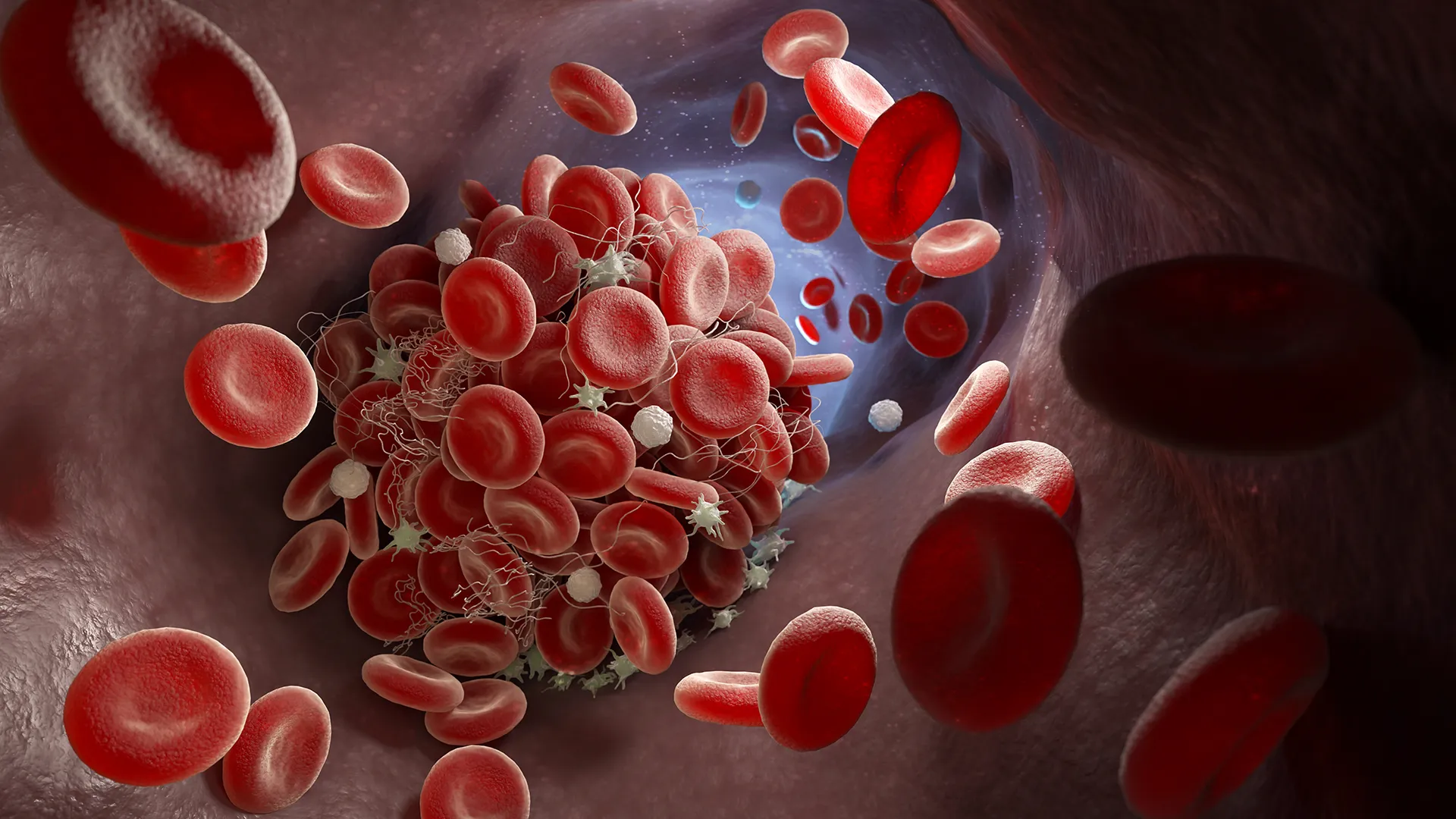 unveiling-Intricacies- hypertrophic-cardiomyopathy-blood-clot
